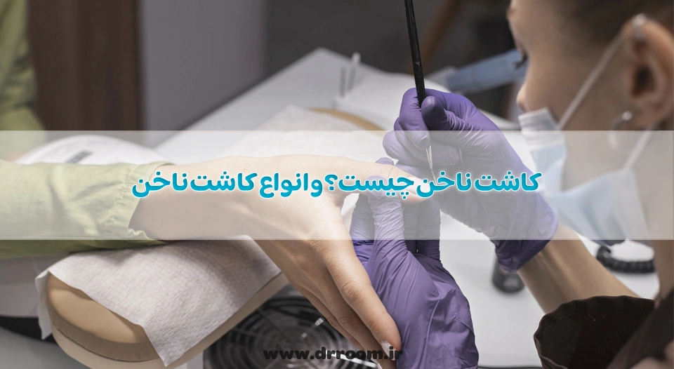کاشت ناخن چیست؟ و انواع کاشت ناخن