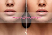 تفاوت فیلر لب با ژل لب چیست؟