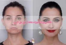 عکس ورم صورت بعد از تزریق چربی