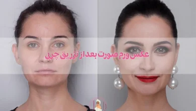 عکس ورم صورت بعد از تزریق چربی