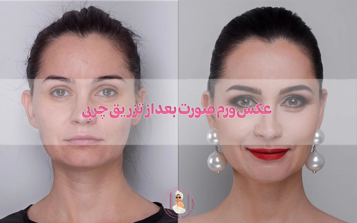 عکس ورم صورت بعد از تزریق چربی