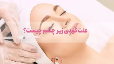 علت گودی زیر چشم چیست؟