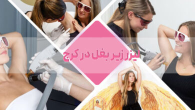 لیزر زیر بغل در کرج