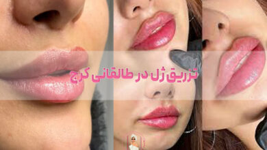 تزریق ژل در طالقانی کرج