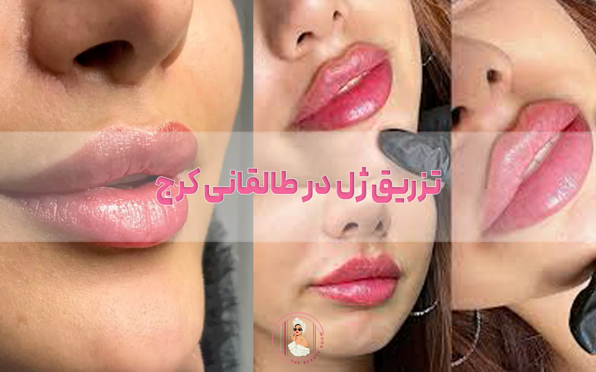 تزریق ژل در طالقانی کرج