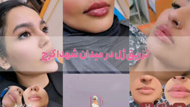 تزریق ژل در میدان شهدا کرج