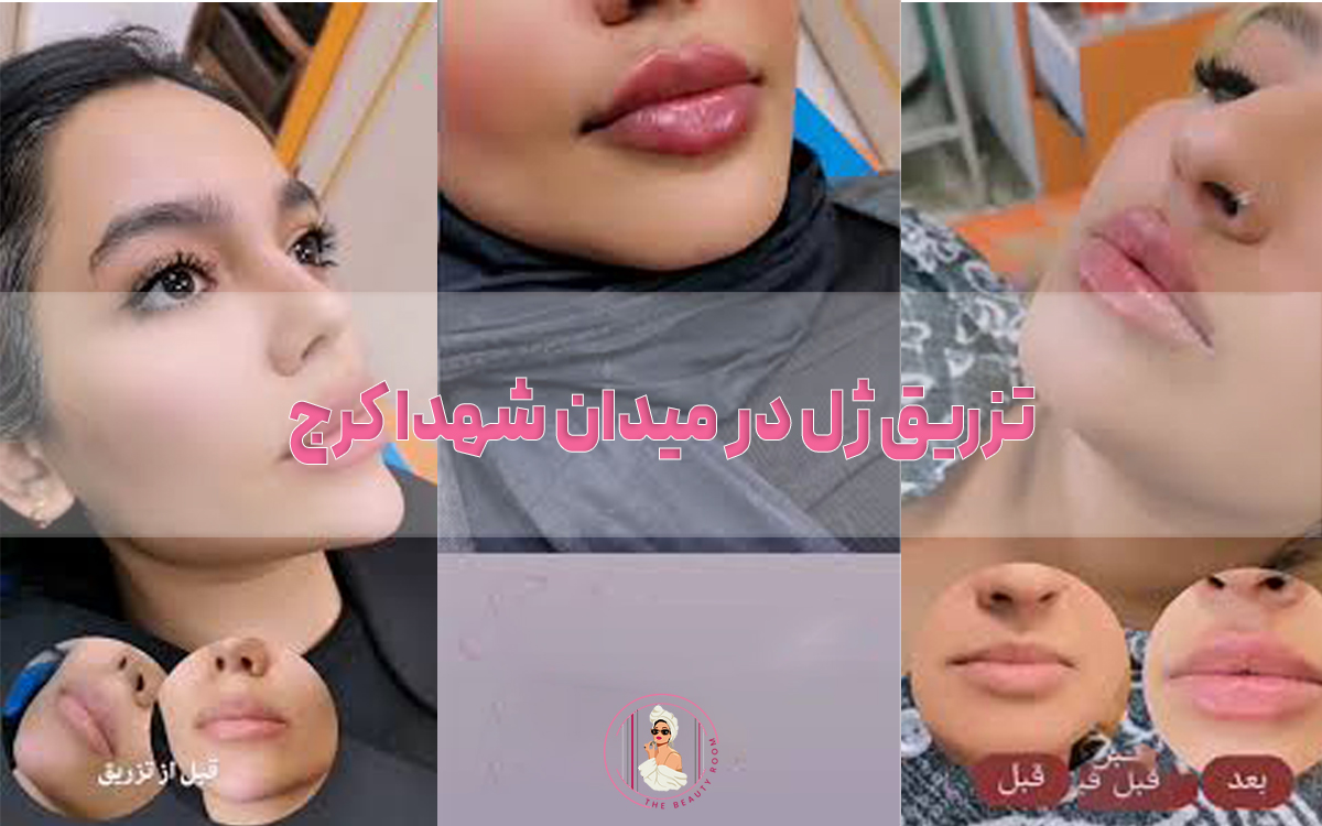 تزریق ژل در میدان شهدا کرج