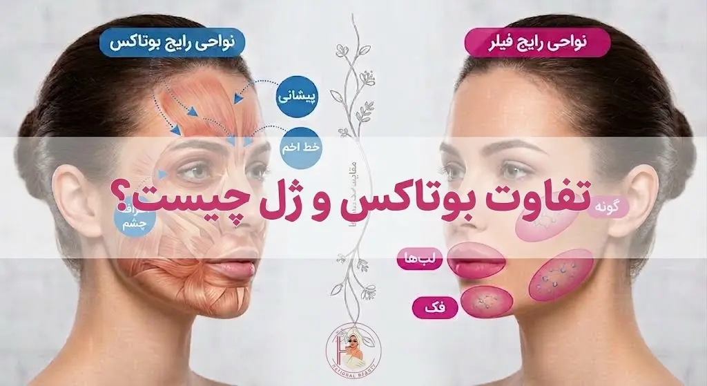 تفاوت بوتاکس و ژل
