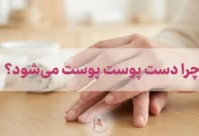 علت پوست پوست شدن دست ها چیست؟