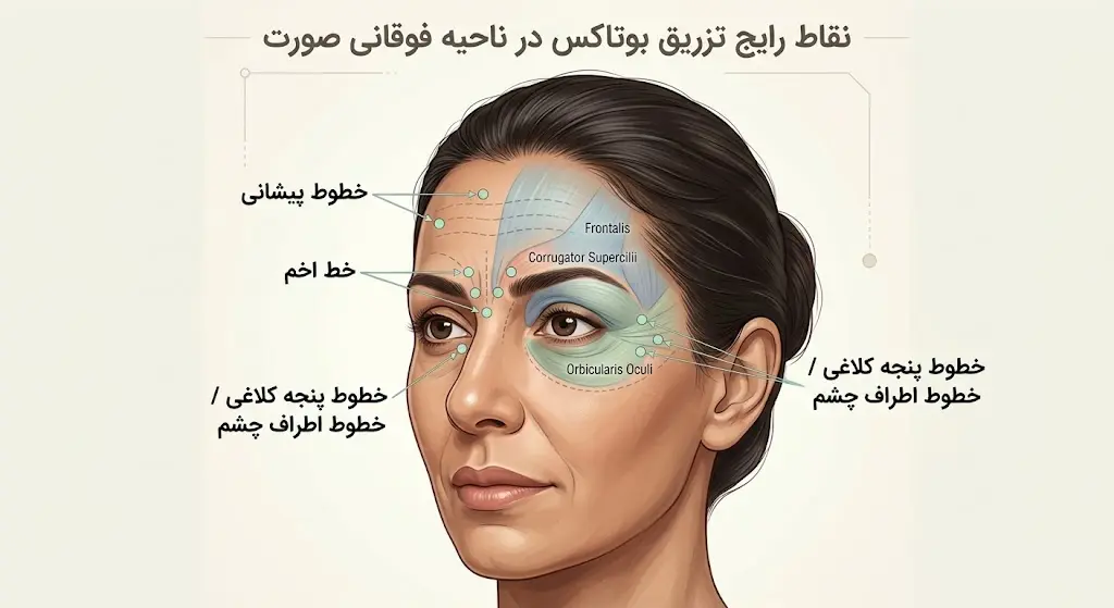 نواحی رایج بوتاکس